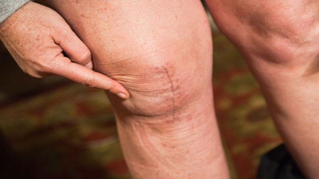 Cara Mengatasi Asam Urat pada Lutut
